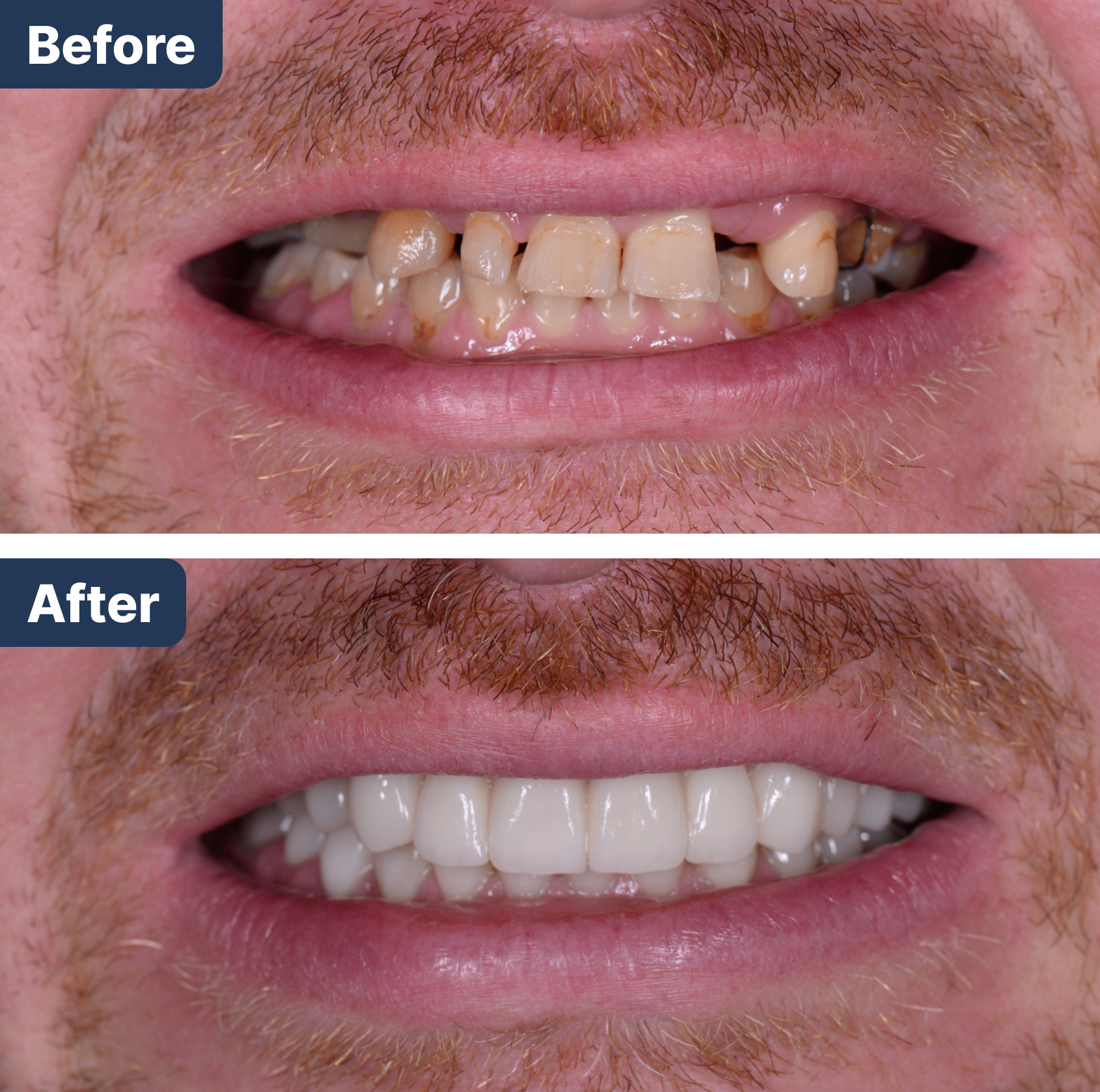 Before and after dental treatment in Mundelein
