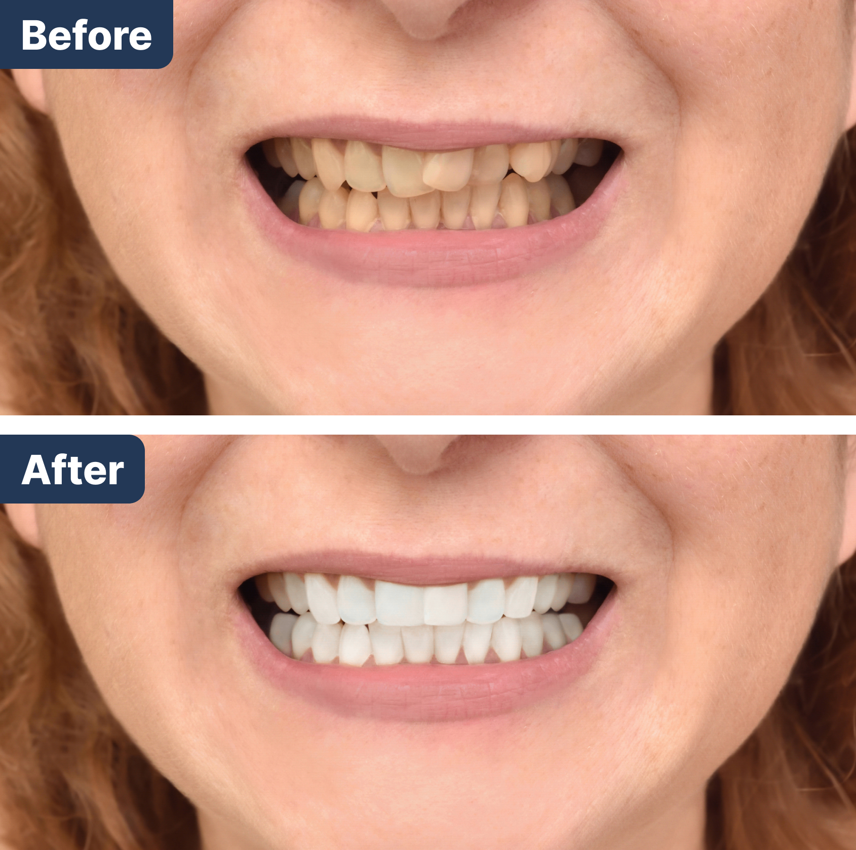 Before and after dental treatment in Mundelein